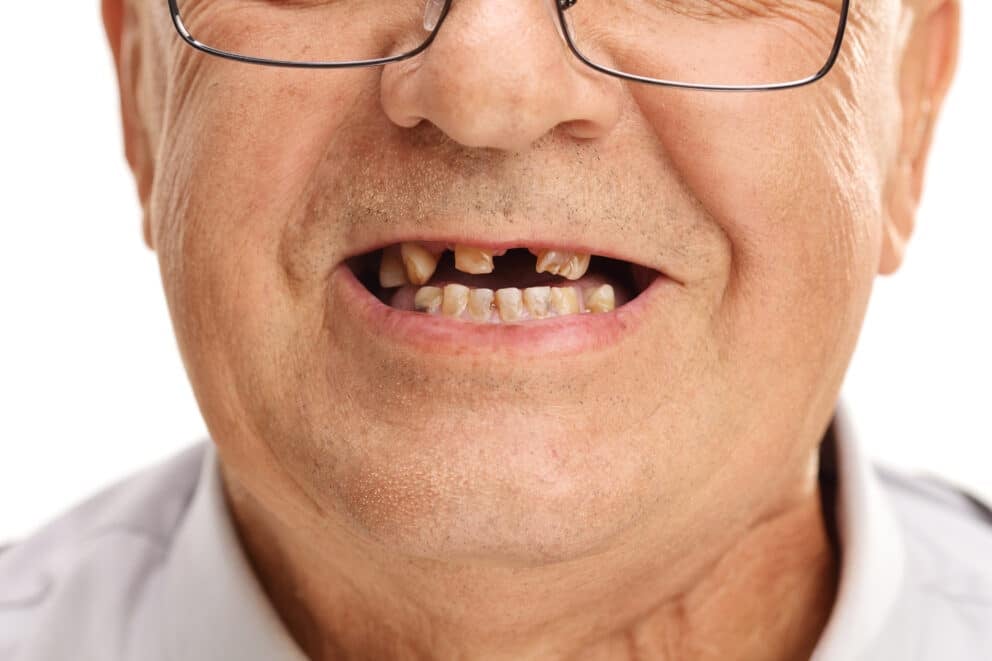 “Oops, I Chipped It Again!” What to Do In a Dental Emergency